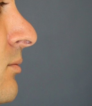 Rhinoplasty 215 - before - front