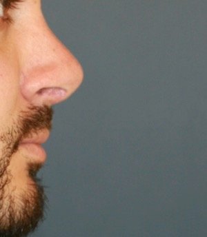 Rhinoplasty 215 - after - front