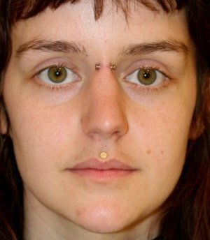 Rhinoplasty 216 - before - side