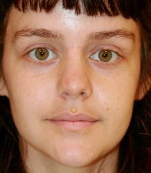 Rhinoplasty 216 - after - side