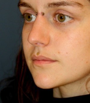 Rhinoplasty 216 - before - oblique
