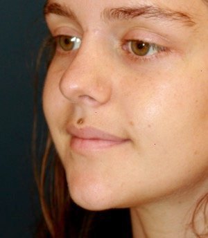 Rhinoplasty 216 - after - oblique