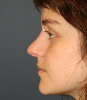 Rhinoplasty 216 - before - front