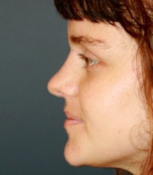 Rhinoplasty 216 - after - front