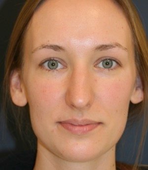 Rhinoplasty 217 - before - front
