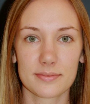 Rhinoplasty 217 - after - front