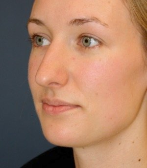 Rhinoplasty 217 - before - oblique