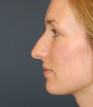 Rhinoplasty 217 - before - side
