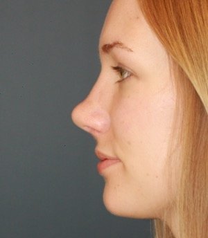 Rhinoplasty 217 - after - side