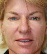 Rhinoplasty Case 16 - before - front