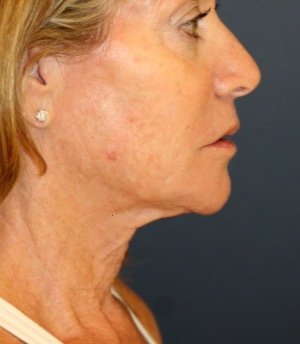 Necklift 207 - before - front