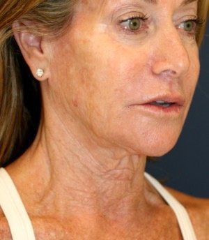 Necklift 207 - before - oblique