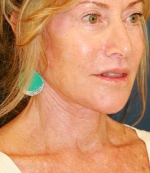 Necklift 207 - after - oblique