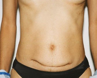 Revision Abdominoplasty - before - front