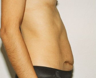 Revision Abdominoplasty - before - side