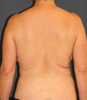 Waist to Butt 1 - before - front