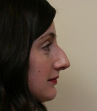 Rhinoplasty Case 18 - before - front
