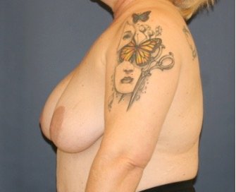 Breast Augmentation Lift 69 - before - side