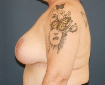 Breast Augmentation Lift 69 - after - side
