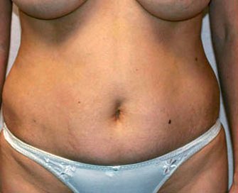 Tummy Tuck Case 10 - before - front