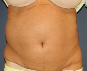 Tummy Tuck 250 - before - front