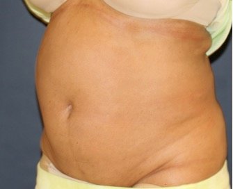 Tummy Tuck 250 - before - oblique