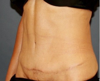 Tummy Tuck 250 - after - oblique