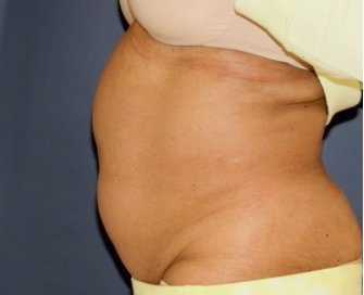 Tummy Tuck 250 - before - side
