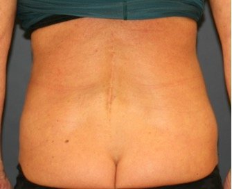 Liposuction 218 Back-Waist-Flanks - before - front