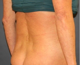 Liposuction 218 Back-Waist-Flanks - before - oblique
