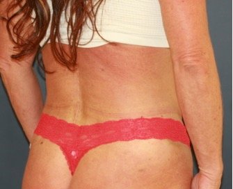 Liposuction 218 Back-Waist-Flanks - after - oblique