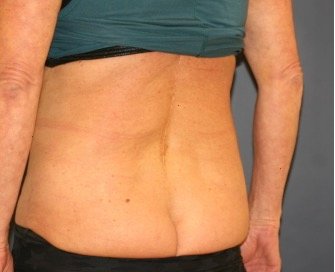 Liposuction 218 Back-Waist-Flanks - before - side