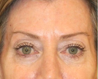 Blepharoplasty 112 - before - front