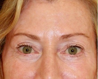 Blepharoplasty 112 - after - front
