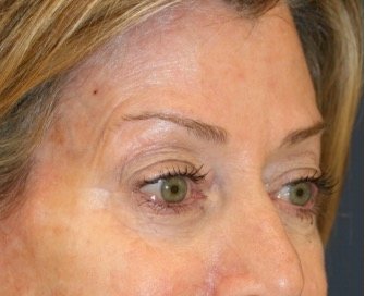 Blepharoplasty 112 - before - oblique