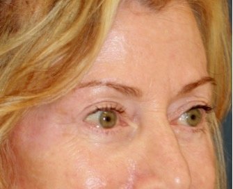 Blepharoplasty 112 - after - oblique