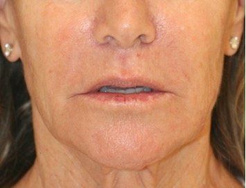 Lip Lift and Corner Lip Lift 213 - before - front