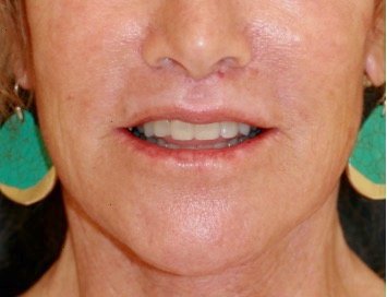 Lip Lift and Corner Lip Lift 213 - after - front