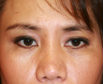 Blepharoplasty Case 27 - before - front