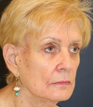 Facelift 106 - before - oblique