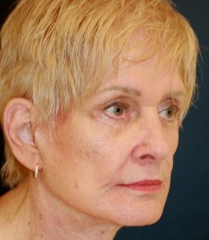 Facelift 106 - after - oblique