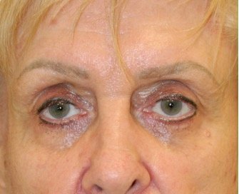 Blepharoplasty 113 - before - front