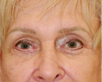 Blepharoplasty 113 - after - front