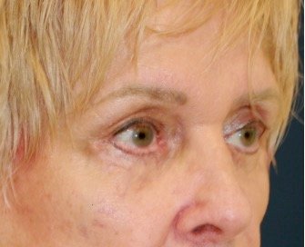 Blepharoplasty 113 - after - oblique