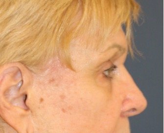 Blepharoplasty 113 - before - side