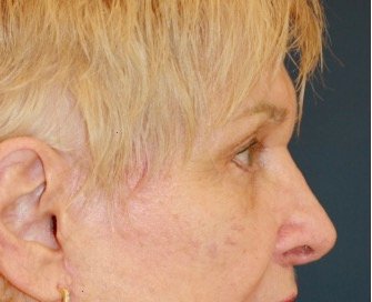 Blepharoplasty 113 - after - side