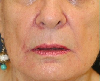 Lip Lift and Corner Lip Lift 214 - before - front