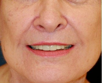 Lip Lift and Corner Lip Lift 214 - after - front
