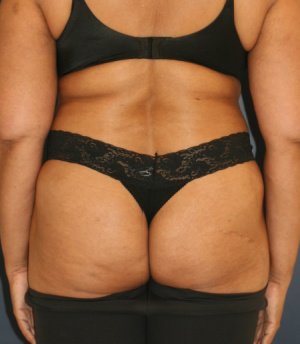 Waist to Butt 8 - before - front