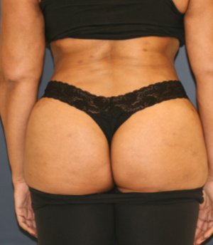 Waist to Butt 8 - after - front